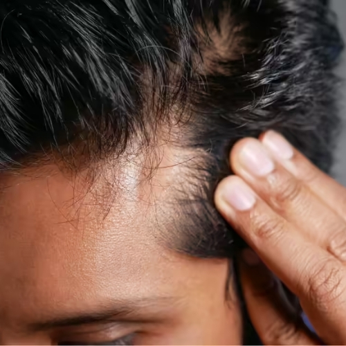 Hair fall treatment in Keesara
